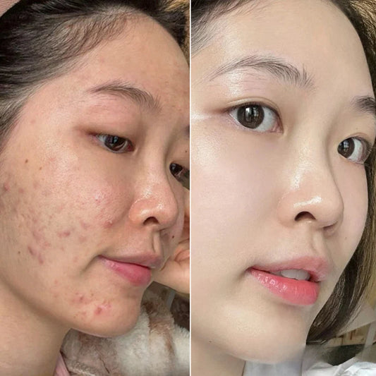 Oily & Acne-Prone Skin Combo – Control Oil, Clear Breakouts, and Soothe Skin