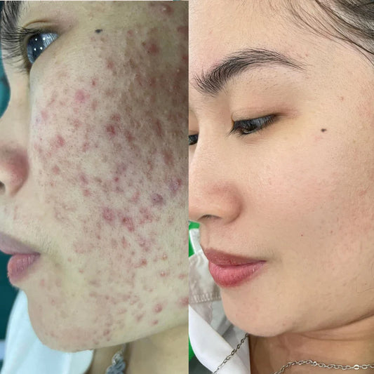 Oily & Acne-Prone Skin Combo – Control Oil, Clear Breakouts, and Soothe Skin