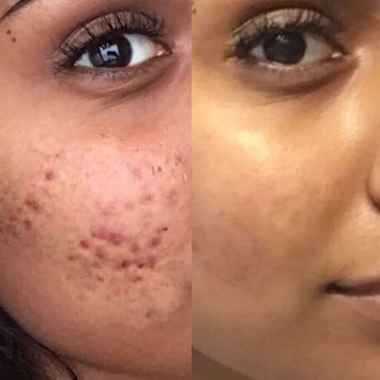 Oily & Acne-Prone Skin Combo – Control Oil, Clear Breakouts, and Soothe Skin