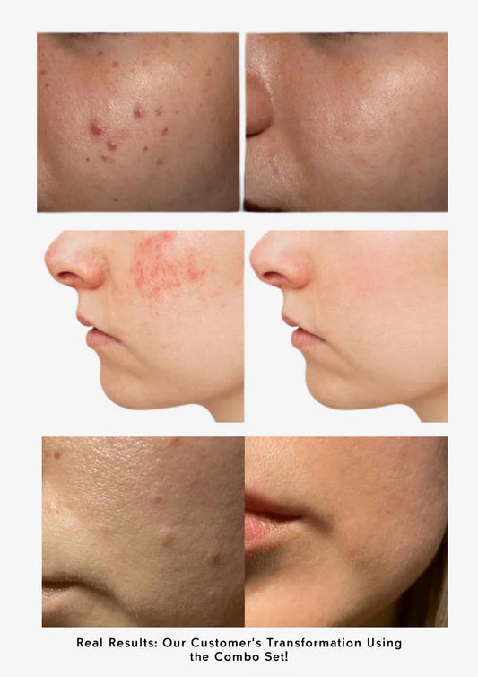 Oily & Acne-Prone Skin Combo – Control Oil, Clear Breakouts, and Soothe Skin